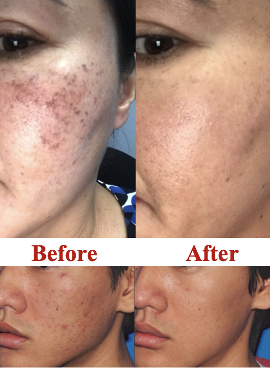 Microneedling Before & After