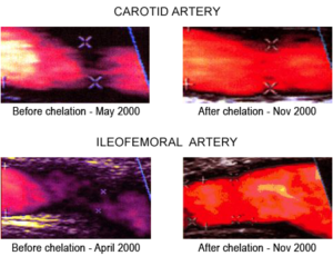 Carotid Artery and Ileofemoral Artery